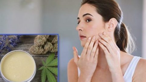 CBD acne cream DIY recipe