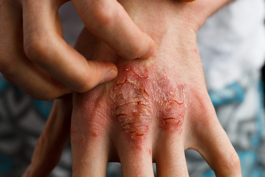 cbd-and-psoriasis