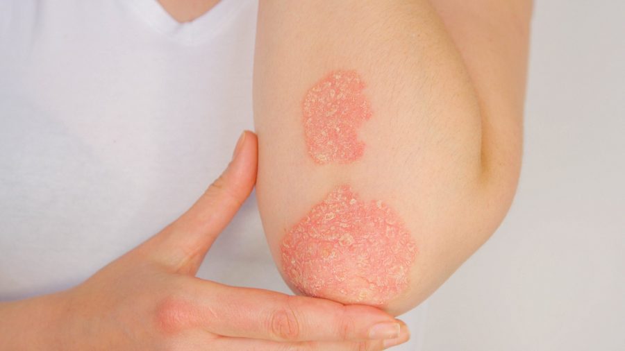 psoriasis-and-cbd