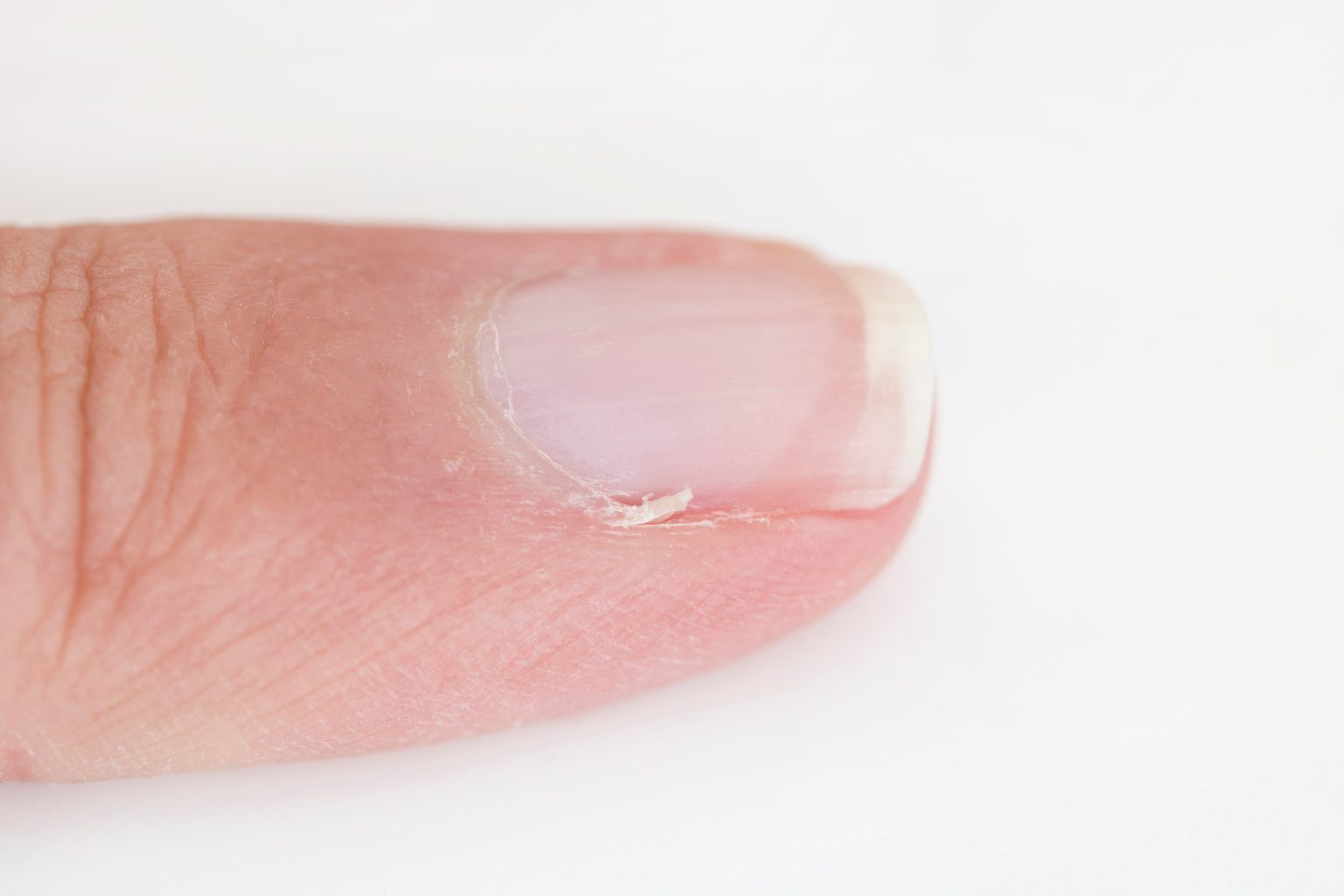 Antibiotic Cream For Infected Hangnail